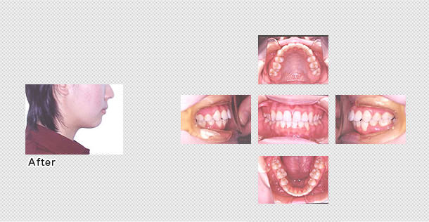 キレイな歯並び