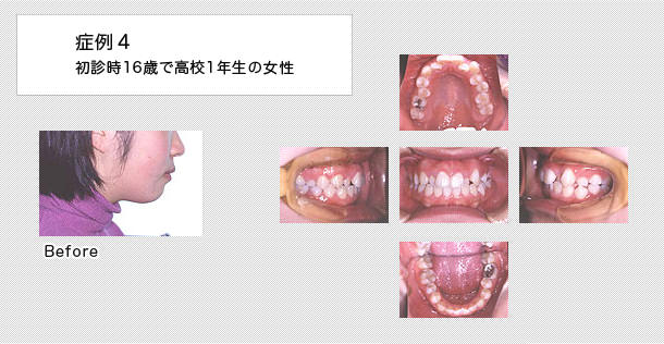 16歳高校一年生の女性の症例
