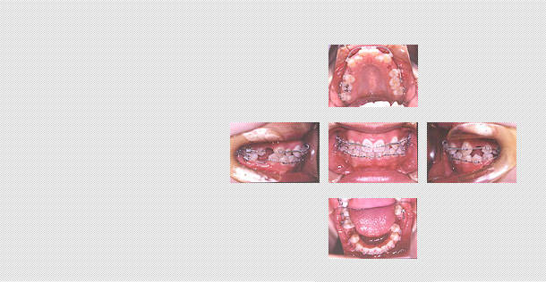 抜歯後、表側の矯正