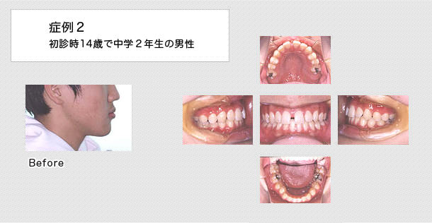 14歳で中学2年生の男の子の症例