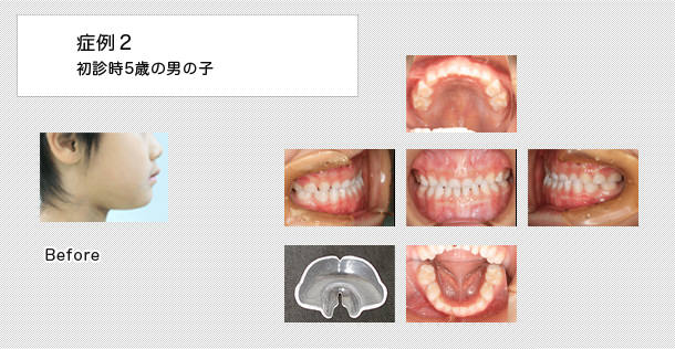 5歳の男の子の症例