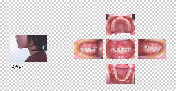 受け口でも良好な治療経過に
