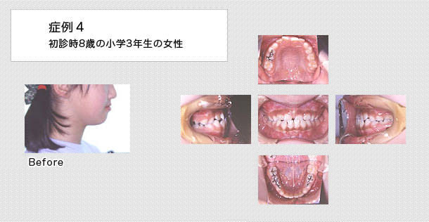 8歳で小学3年生の女の子の症例