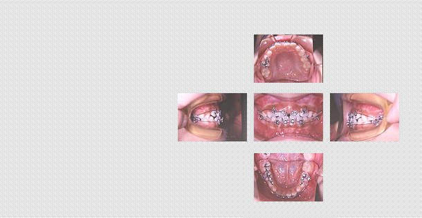 前歯の噛み合わせ治療