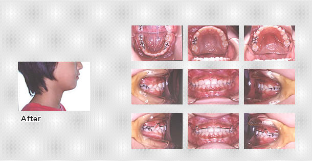 4か月で受け口の治療終了