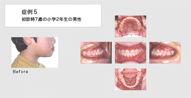 7歳で小学2年の男の子の症例