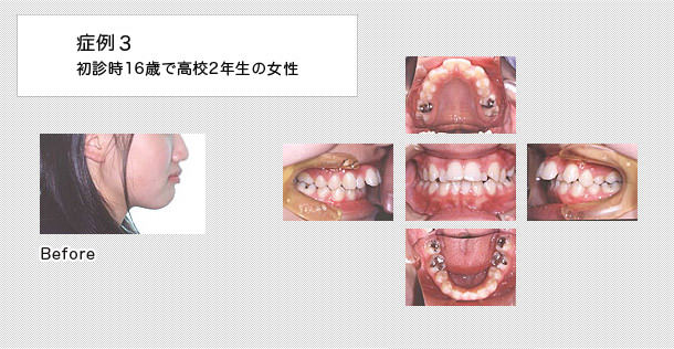 裏側矯正症例１