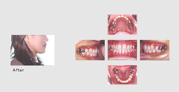 治療後の歯並び