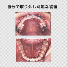 部分的な矯正治療の症例写真