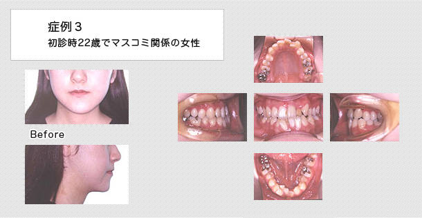 顔面非対称　ケース３