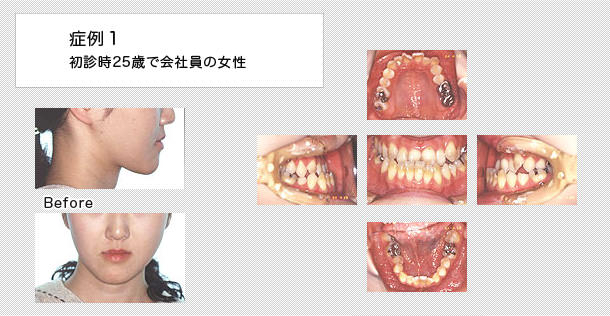 外科的矯正　ケース１