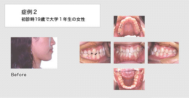 外科的矯正　ケース２