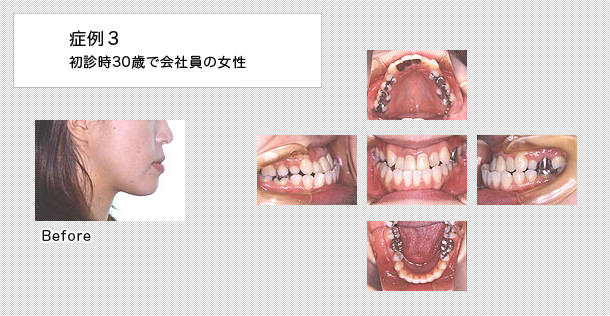 外科的矯正　ケース３