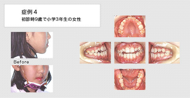 外科的矯正　ケース４