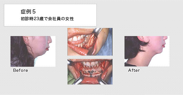 外科的矯正　ケース５