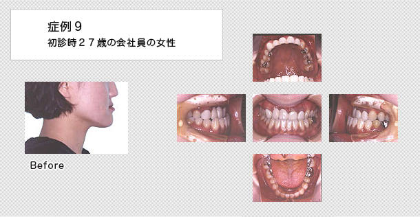 外科的矯正　ケース９