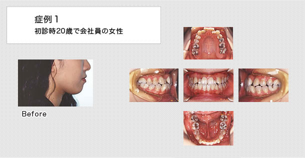 一般的な矯正　ケース１