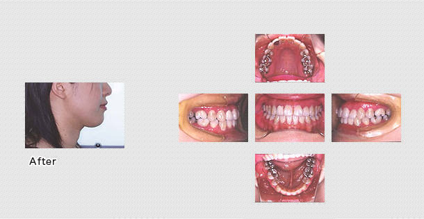 一般的な矯正　ケース１