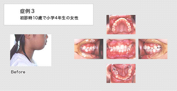 連続抜歯　ケース３