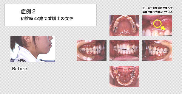 口元が出ている　ケース２