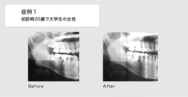 親不知　ケース１