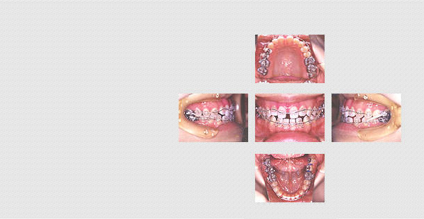 すきっ歯　ケース１