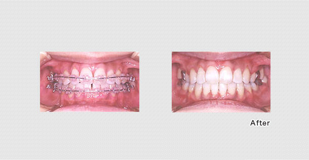 プロキシマルリダクション