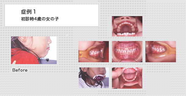 受け口　ケース１（幼児期）