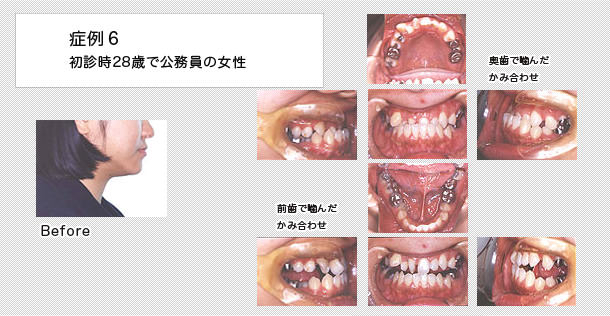 受け口　ケース６