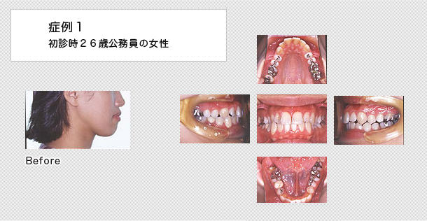 舌側矯正　ケース１