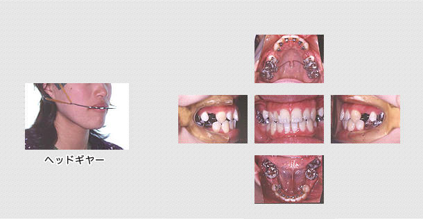 舌側矯正　ケース１