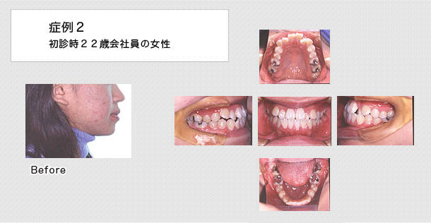 舌側矯正　ケース２