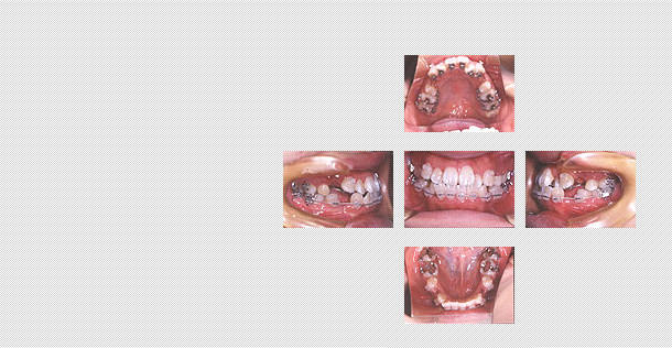 舌側矯正　ケース２