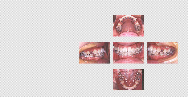 舌側矯正　ケース２