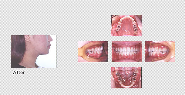 舌側矯正　ケース２