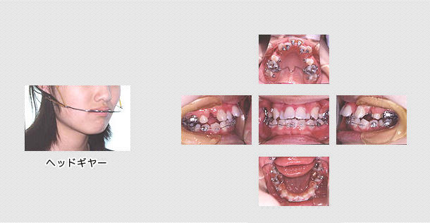舌側矯正　ケース３