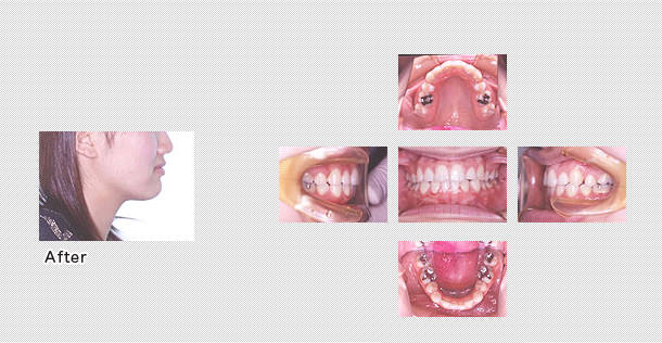 舌側矯正　ケース３