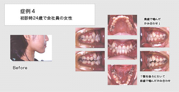 舌側矯正　ケース４