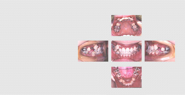 舌側矯正　ケース４