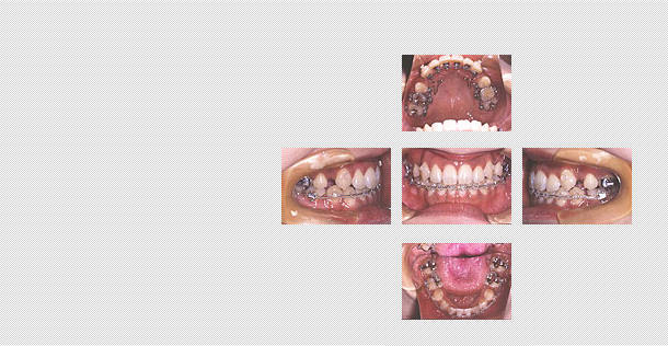 舌側矯正　ケース４