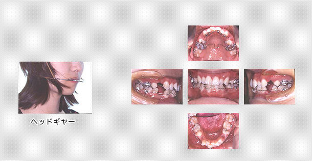 舌側矯正　ケース５