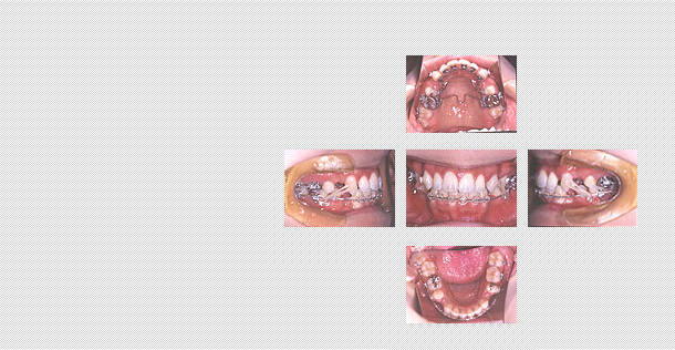 舌側矯正　ケース５