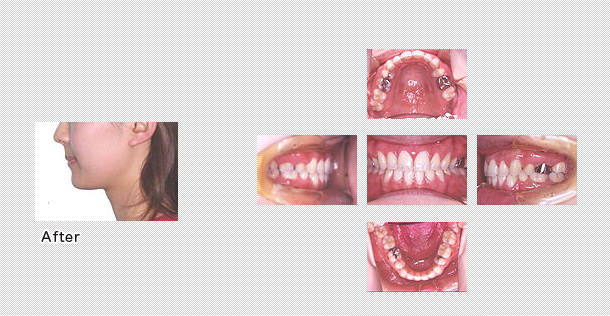 舌側矯正　ケース５