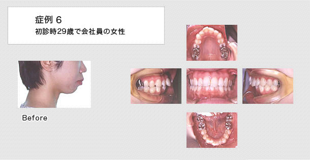 舌側矯正　ケース６