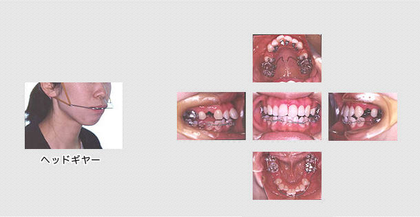 舌側矯正　ケース６