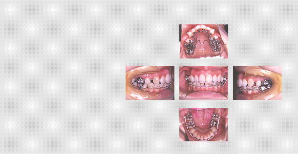 舌側矯正　ケース６