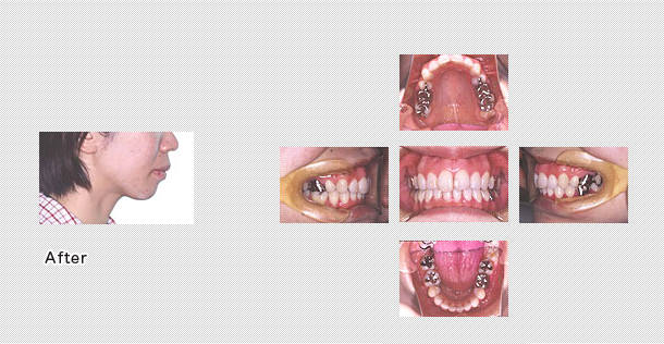 舌側矯正　ケース６