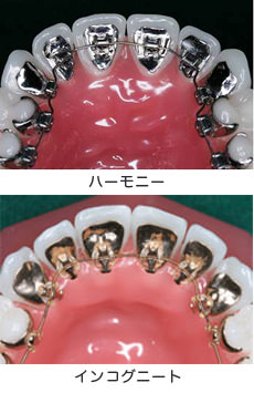 舌側矯正治療（歯の裏側に装置をつける見えにくい矯正）